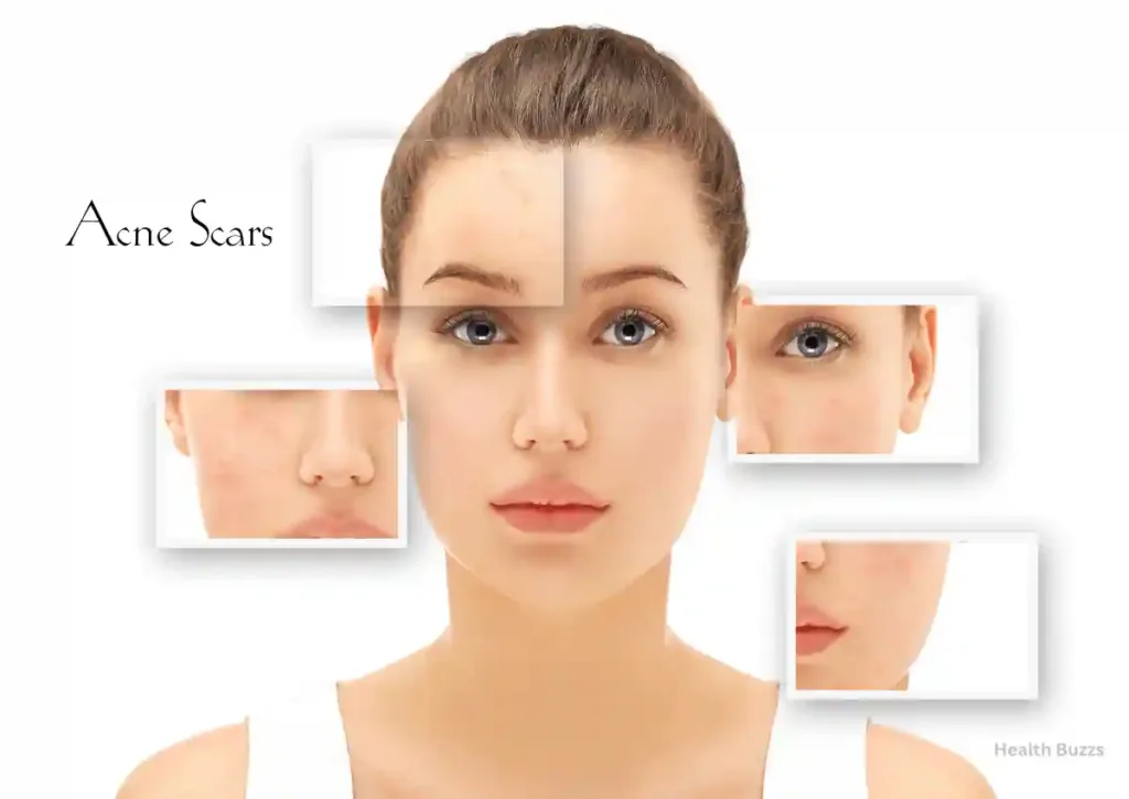 Benefits of Kojic Acid for Acne Scars