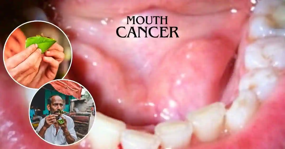 12 Signs of Mouth Cancer from Chewing Tobacco