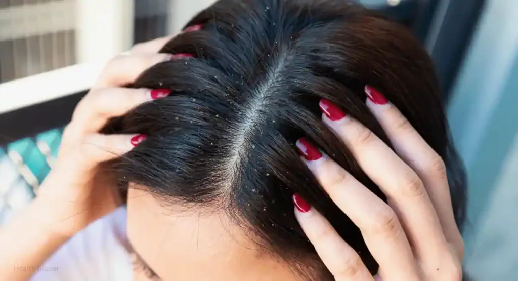 Hair scalp with dandruff and scaly from psoriasis.