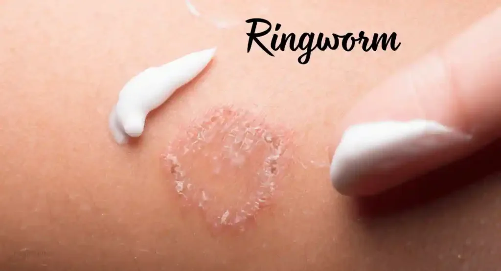  Ringworm