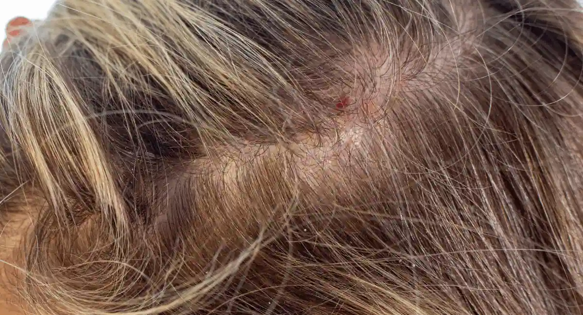 Psoriasis of the scalp, psoriatic redness, peeling, and crusts on the scalp of an unrecognizable woman. An autoimmune, incurable dermatological skin disease.