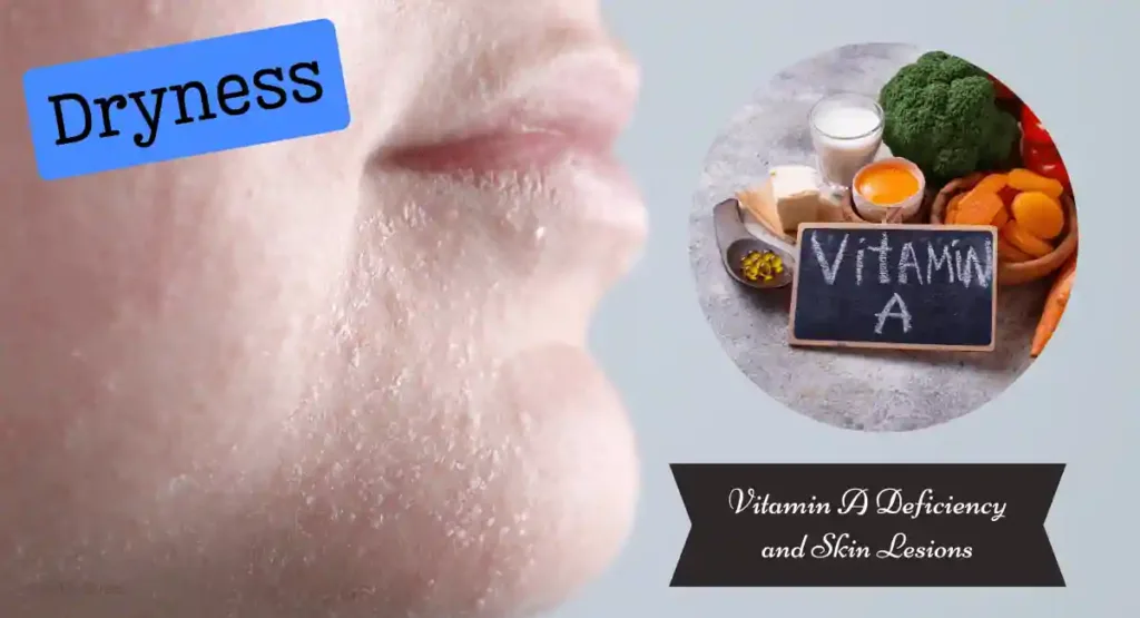 Vitamin A Deficiency and Skin Lesions