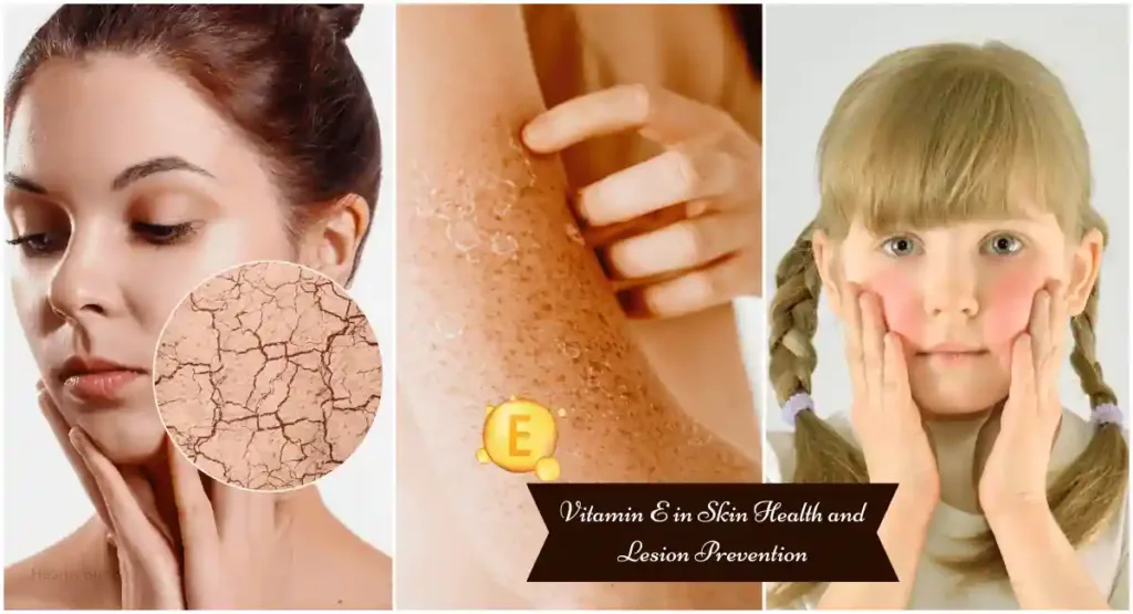 Vitamin E in Skin Health and Lesion Prevention