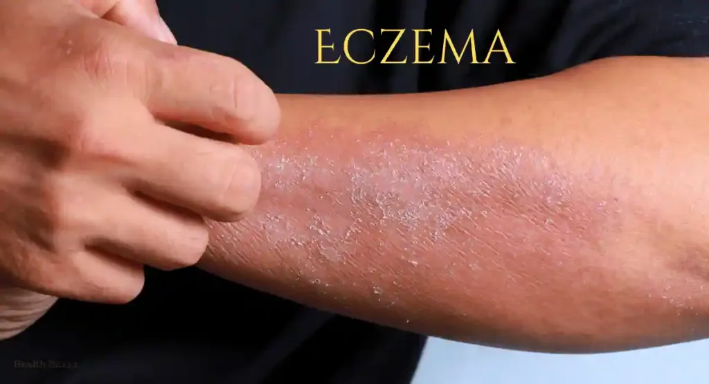 Eczema