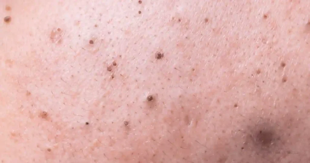 What to do after removing blackheads